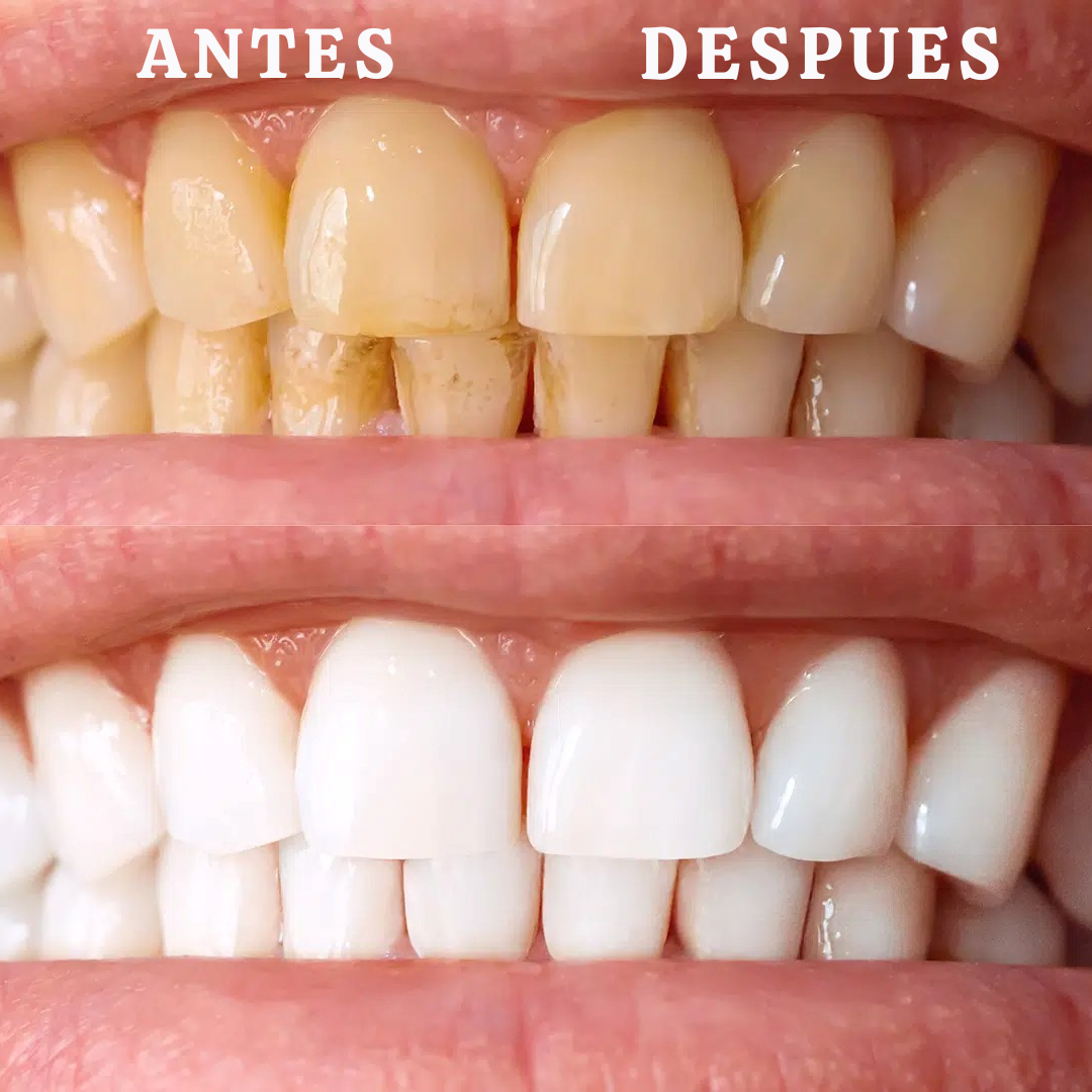 Blanqueador dental UV Consigue una sonrisa perfecta en solo 20 minutos.