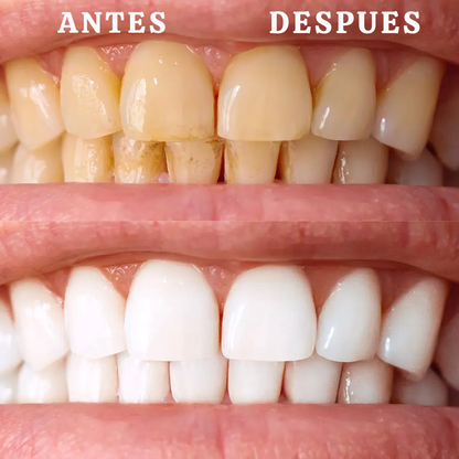 Blanqueador dental UV Consigue una sonrisa perfecta en solo 20 minutos.